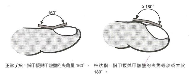 怎樣看出心臟有問題 從手指、舌頭眼神測(cè)試