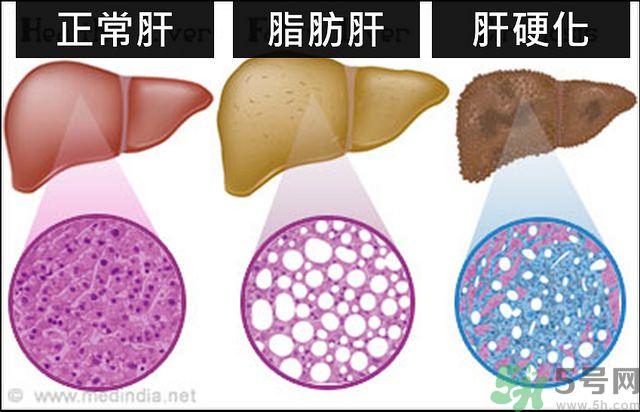 得了脂肪肝該怎么治？脂肪肝對人體危害有多大？