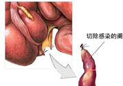 闌尾手術(shù)會(huì)影響結(jié)腸嗎？闌尾手術(shù)術(shù)后要注意什么？