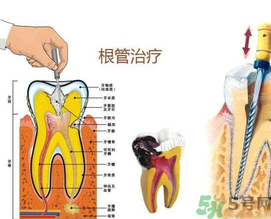 什么是根管治療？為什么牙齒疼要做根管治療？