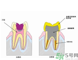 什么是根管治療？為什么牙齒疼要做根管治療？