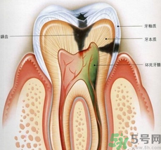 什么是根管治療？為什么牙齒疼要做根管治療？