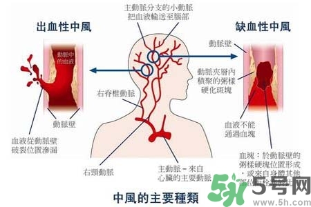 腦中風(fēng)是什么？腦中風(fēng)的癥狀？