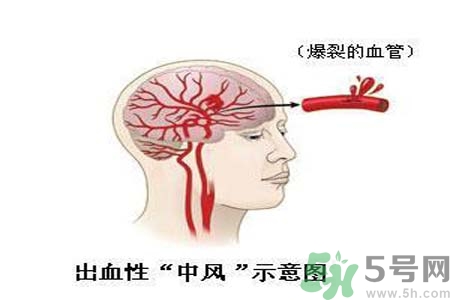 腦中風(fēng)的護(hù)理措施？腦中風(fēng)的飲食護(hù)理？