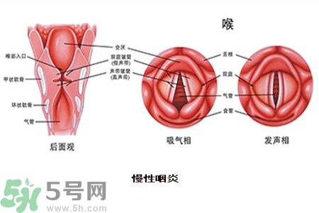 慢性咽炎是什么？慢性咽炎的癥狀有哪些？