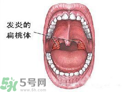 慢性咽炎是什么？慢性咽炎的癥狀有哪些？