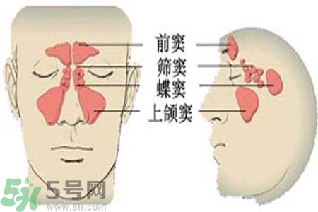 鼻竇炎是什么？鼻竇炎的癥狀有哪些？