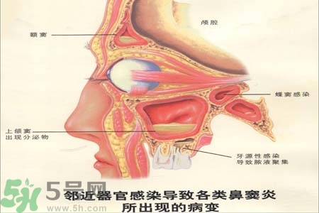 鼻竇炎是什么？鼻竇炎的癥狀有哪些？