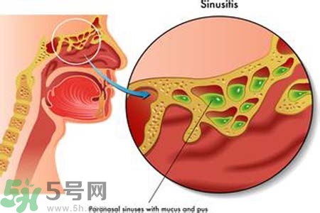 鼻竇炎的護(hù)理措施？鼻竇炎的飲食護(hù)理？