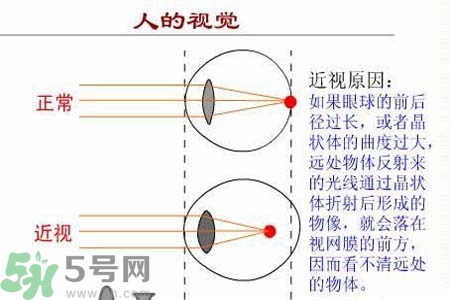 近視眼的發(fā)病因素？近視眼的并發(fā)癥有哪些？