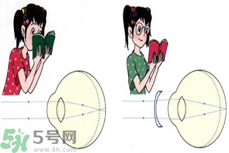 近視眼的發(fā)病因素？近視眼的并發(fā)癥有哪些？