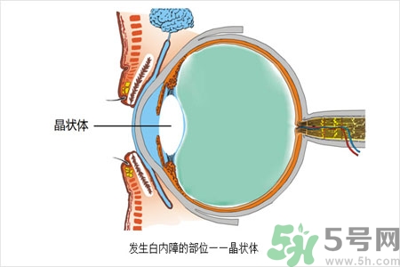 白內(nèi)障的護(hù)理措施是什么？白內(nèi)障的飲食護(hù)理有哪些？