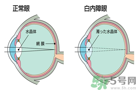 白內(nèi)障的發(fā)病因素是什么？白內(nèi)障并發(fā)癥有哪些？