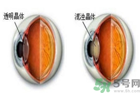 白內(nèi)障治療方法是什么？白內(nèi)障可以用什么藥物治療？