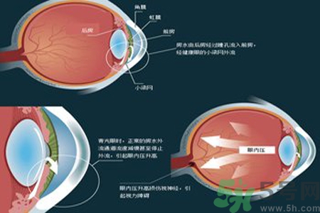 青光眼是什么？青光眼癥狀有什么？