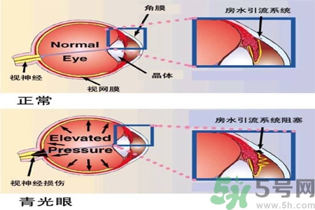 青光眼的護(hù)理措施有什么？青光眼的飲食護(hù)理有哪些？