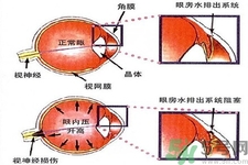 青光眼的發(fā)病因素是什么？青光眼的并發(fā)癥有哪些？