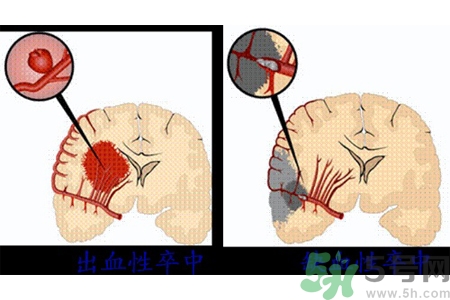 腦出血的發(fā)病因素是什么？腦出血的并發(fā)癥有哪些？