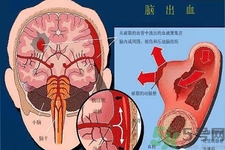 腦出血的發(fā)病因素是什么？腦出血的并發(fā)癥有哪些？