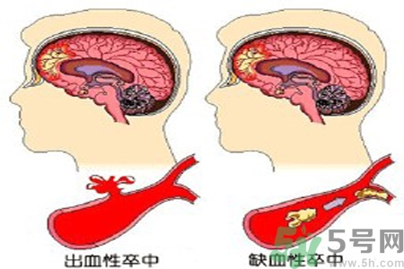 腦出血的治療方法是什么？腦出血可以用哪些藥物治療？