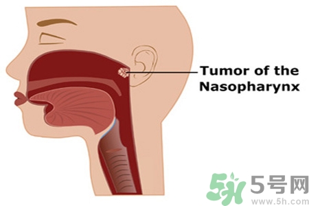 鼻咽癌的日常措施是什么？鼻咽癌注意的飲食有哪些？