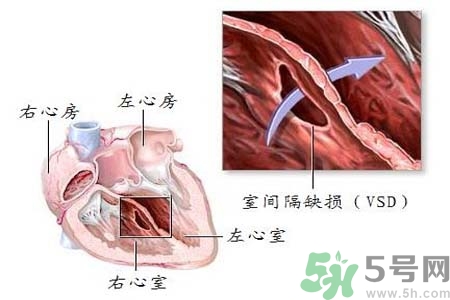 先天性心臟病是什么？先天性心臟病的癥狀有哪些？