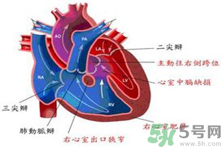 先天性心臟病發(fā)病原因是什么？