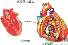 先天性心臟病發(fā)病原因是什么？