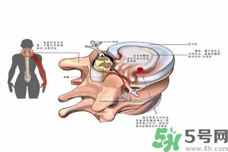 為什么年輕人容易得頸椎??？頸椎病嚴(yán)重的癥狀有哪些？