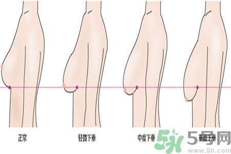 ?女性乳房下垂的原因是什么？女性乳房下垂的分類有哪些？