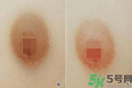 乳頭發(fā)黑怎么辦？怎么樣可以使乳頭變白？