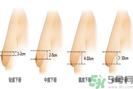 胸部松弛的原因是什么？胸部松弛該怎么辦？