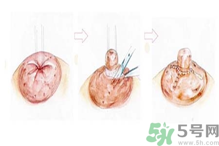 乳頭內(nèi)陷怎么回事？乳頭內(nèi)陷的原因是什么？