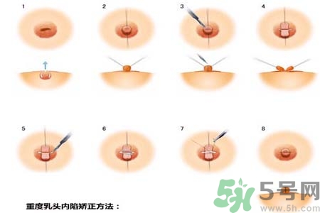 乳頭內(nèi)陷怎么回事？乳頭內(nèi)陷的原因是什么？