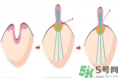 乳頭內(nèi)陷怎么辦？乳頭內(nèi)陷的癥狀有哪些？