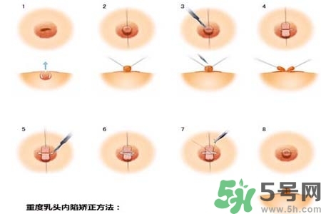 乳頭內(nèi)陷怎么辦？乳頭內(nèi)陷的癥狀有哪些？