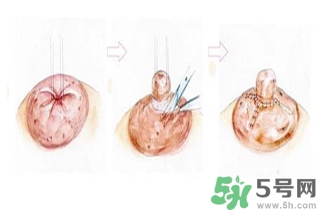 乳頭內(nèi)陷怎么辦？乳頭內(nèi)陷的癥狀有哪些？