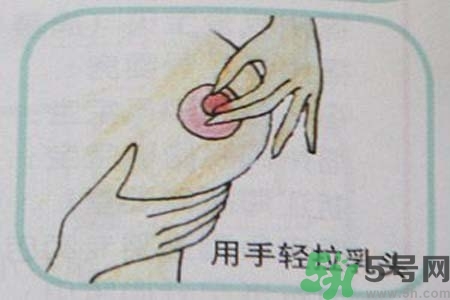 乳頭內(nèi)陷怎么辦？乳頭內(nèi)陷的癥狀有哪些？