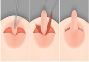 乳頭內(nèi)陷怎么辦？乳頭內(nèi)陷的癥狀有哪些？