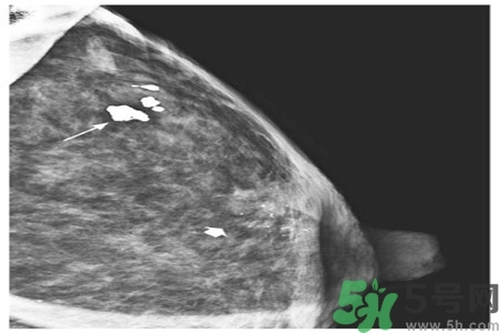 乳腺增生鈣化是什么？乳腺鈣化的癥狀有哪些？