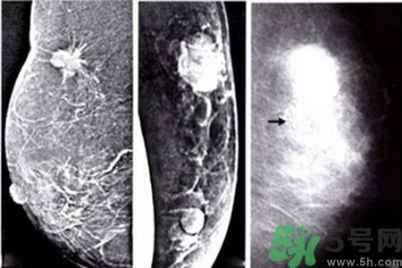 乳腺增生鈣化是什么？乳腺鈣化的癥狀有哪些？