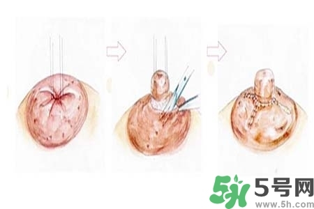 乳頭內(nèi)陷怎么矯正？乳頭內(nèi)陷矯正方法是什么？