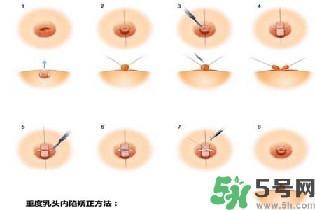 乳頭內(nèi)陷怎么矯正？乳頭內(nèi)陷矯正方法是什么？