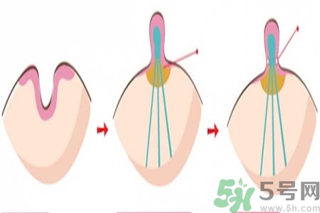 乳頭內(nèi)陷矯正需注意什么？乳頭內(nèi)陷如何預防？