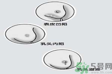 乳頭內(nèi)陷矯正需注意什么？乳頭內(nèi)陷如何預防？