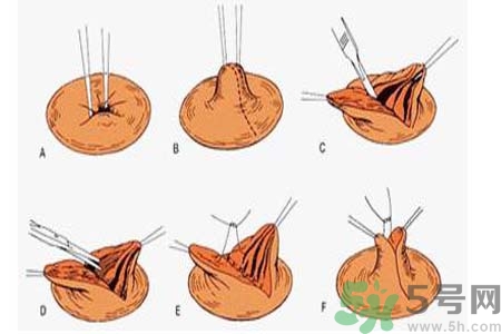 乳頭內(nèi)陷可以拔罐嗎？乳頭內(nèi)陷需要手術(shù)治療嗎？