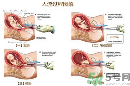 人工流產(chǎn)后多久可以再次懷孕？流產(chǎn)后需要注意什么？