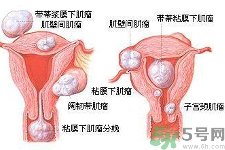 ?子宮移位怎么治療？子宮移位能懷孕嗎？