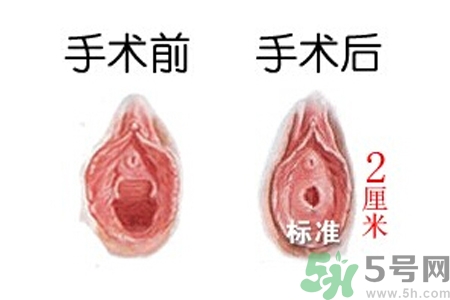 什么人不能做處女膜修補(bǔ)術(shù)？處女膜修補(bǔ)術(shù)會留疤嗎？