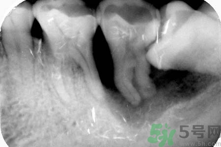 拔智齒一顆多少錢？拔除智齒收費(fèi)多少？